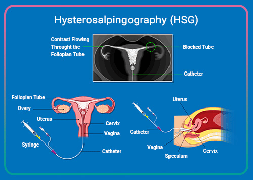 HSG Test in Kharadi