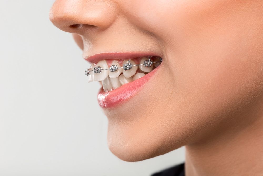 Dental Aligners In Kondhwa