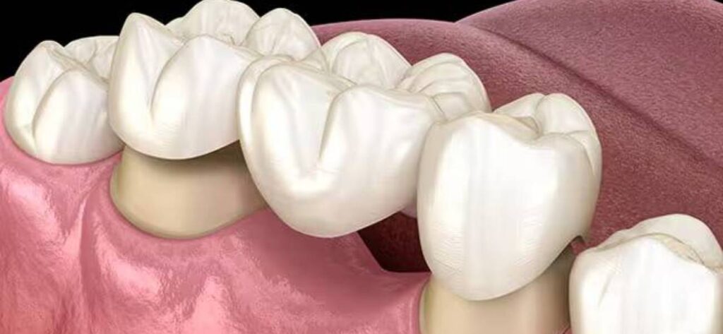 dental implants in kharadi