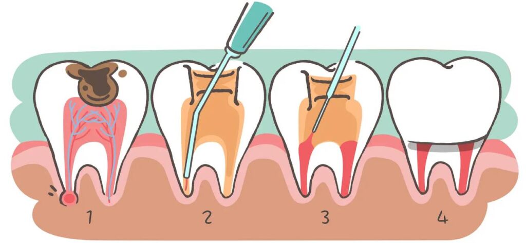 Root Canal Treatments in kharadi