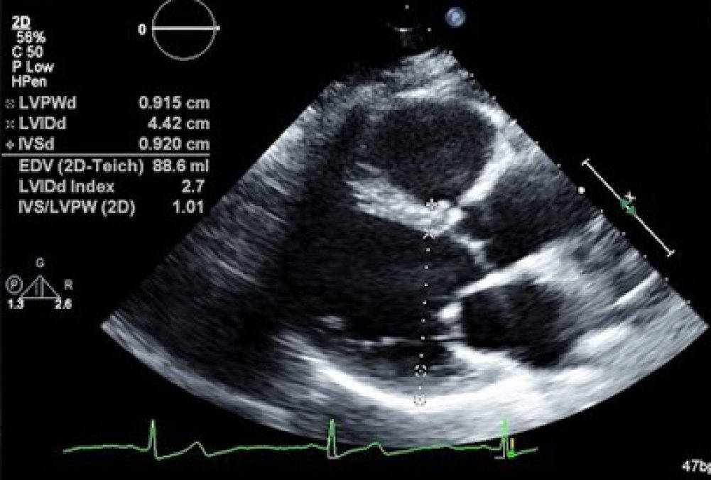 2D Echo Result Image - Qtest Diagnostics Kharadi, Pune